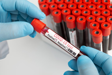 Researcher studying patient's blood in a laboratory. Scientists working with blood infected by...