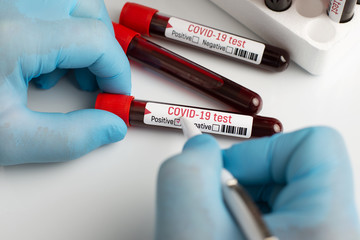 Concept of laboratory test of patient`s blood on coronavirus. Doctor putting checkmark near inscription Positive on test tube