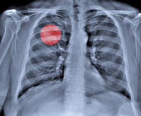 chest x-ray with pneumonia from coronavirus