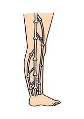 下肢静脈瘤