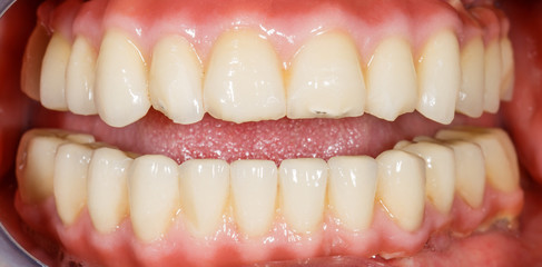 Porcelain, zirconia teeth in human mouth © Ocskay Bence