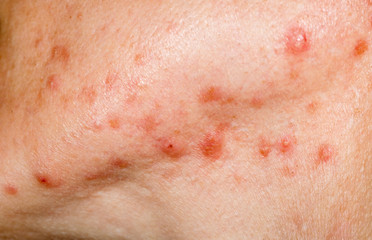 Nodulocystic acne on human skin