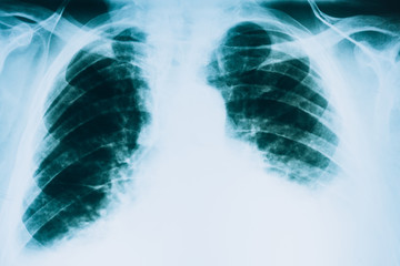 X-ray of the lungs. Fluorogram. Tuberculosis, lung cancer, concept. At the doctor’s appointment, hospital.