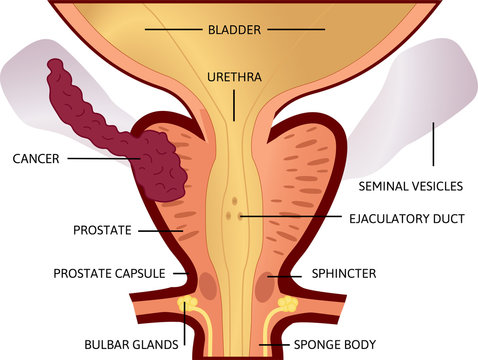 third stage of prostate cancer. The tumor is big and located in prostate and developed into seminal vesicles.