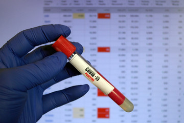 Coronavirus Blood Sample. Testing positive to covid-19. Corona Virus in Lab. Scientist hold tube with Blood Test of pacient . Starting from Wuhan  and reaching the pandemic ,  worldwide report online