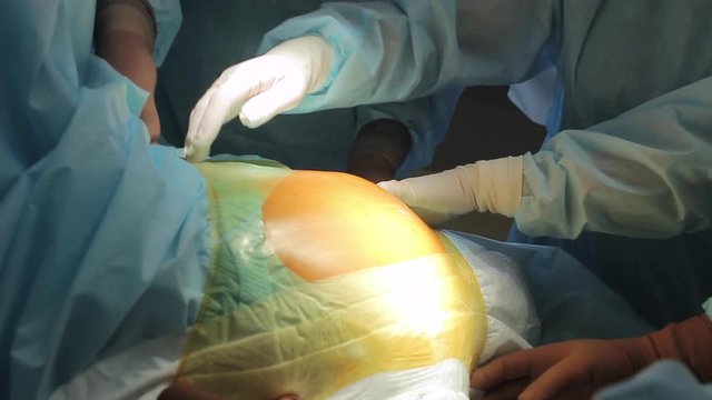 Surgeon with assistans pulls on a membrane and cover surgical area on patient's skin before the surgery 