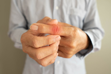 Senior man​ suffering from hand and finger joint pain​ with​ redness.​ Cause of pain...