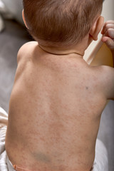 roseola rash a viral rash on the skin of a child