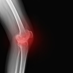 Fototapeta premium Real skeleton x-ray of woman knee suffering from rheumatism. Rheumatoid arthritis knee pain medical concept, medical diagnostics, traumatology and orthopedics