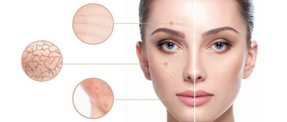 Female face close-up, showing skin problems. Dry skin, acne, wrinkles and other imperfections....