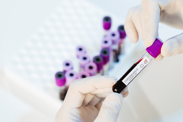 A virologist doctor is examining a sample of a blood test with suspected Covid-19 virus.