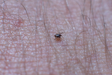 Tick on human skin