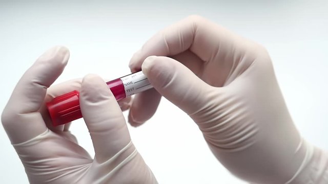 A close-up of the hand of a microbiologist or medical professional with white surgical gloves marking the result of a blood test for a new rapidly spreading coronavirus. COVID-19 Positive Concept