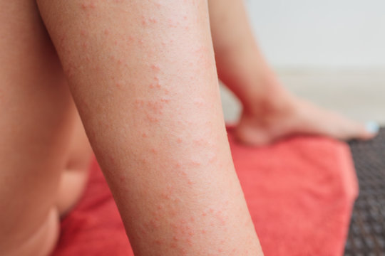 Dermatitis Herpetiformis skin rash in a woman with Nonceliac Gluten Sensitivity. Serum antibodies positive to wheat and gluten. Colonoscopy and upper endoscopy negative for celiac disease.
