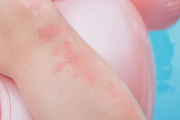 Dermatitis Herpetiformis skin rash in a woman with Nonceliac Gluten Sensitivity. Serum antibodies...