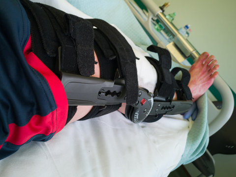 Human Leg with Patches and Orthopedic Brace After Anterior Cruciate Ligament Surgery: in Bed at Hospital