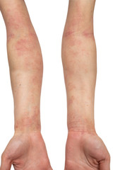 Woman's hand itchy red skin and atopic eczema is on the white background close up