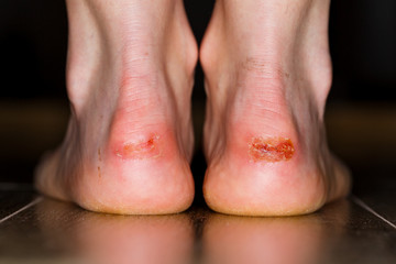 Painful injury on heel