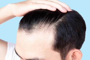 Fototapeta premium Young man serious hair loss problem for health care medical and shampoo product concept, selective focus