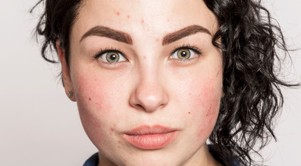 Beautiful brunette girl with problem skin. Acne and redness on the skin. Close-up.