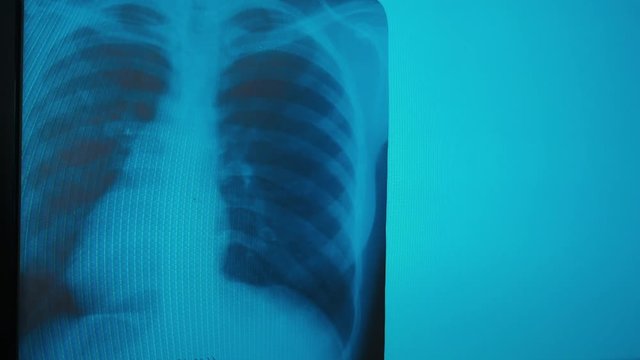 COVID-19. Pneumonia in the lungs in the image of a patient. Doctor of medicine. See Diagnostic Analysis. X-ray center.