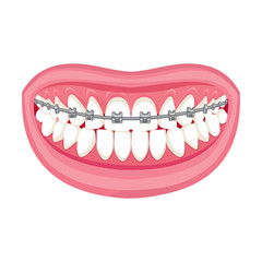 Braces on teeth. pink lips white teeth. White background. 