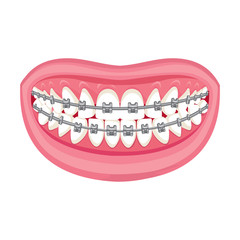 Braces on teeth. pink lips white teeth. White background. 