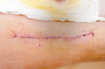 Surgery wound fix with staple on white background.
