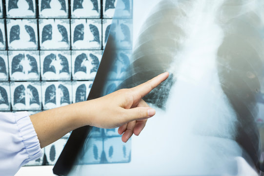 Woman doctor compare patient chest x-ray and CT scan film .Image lung at radiology department in hospital.Covid-19 scan body xray test detection for covid virus epidemic spread concept.