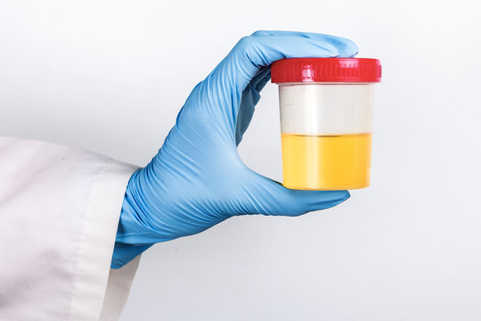 test tube with a urine test in the doctor's gloved hand