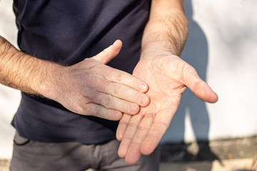 Very dry hands touching, peel due to washing alcohol on Covid19 situation. Horizontal close up of the inside and outside of a very dry cracked male hands. Outside on the street with sunshine