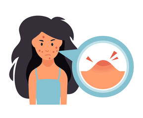 Acne treatment. Unhappy girl struggling with acne,pimples. Skin face irritation problem.