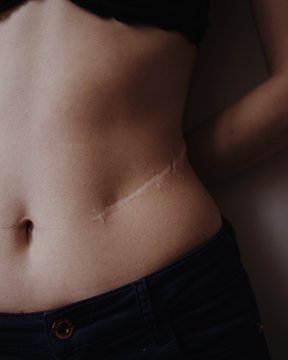 woman body with scar in black