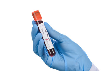 Obraz premium Coronavirus Test Positive