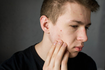 Fototapeta premium Young man struggling with acne on his face caring for his skin pushes acne touches face with her hands and fingers