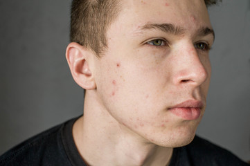 Obraz premium Young man struggling with acne on his face caring for his skin pushes acne