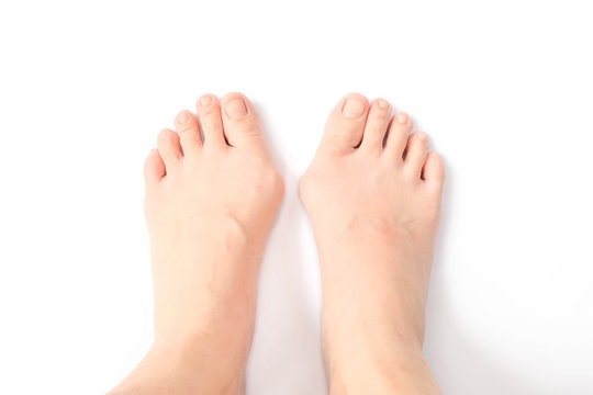 Hallux valgus, feet isolated on white. Hallux valgus is a medical term for bunion foot / bunionette. Hallox Valgus is normally caused by genetic and/or wearing too tight shoes & high heels.