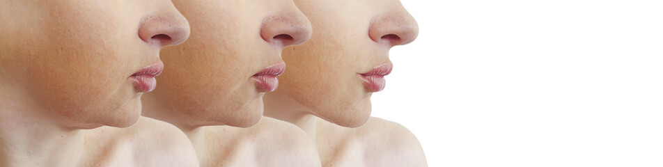 woman double chin before and after treatment