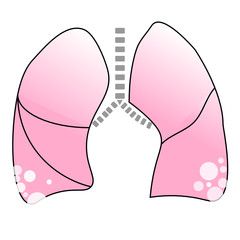 The typical appearance of lung resulted from covid-19 infection which shows peripheral broad based ground glass opacities involving both lower lobes.