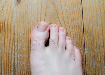Fototapeta premium Broken and not healthy human foot nail