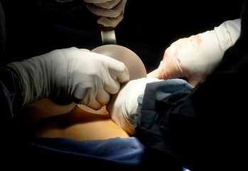 breast augmentation plastic surgery (mammoplasty)
