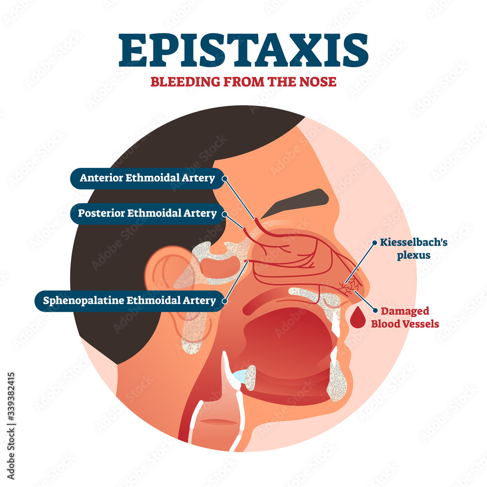 Poster epistaxis vector illustration. bleeding from nose explanation health scheme
