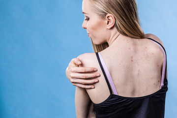 Woman with skin problem acne on back