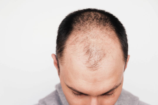 Male pattern hair loss problem concept. Young man losing hair on temples, close up. Space for text. Baldness, alopecia in males.