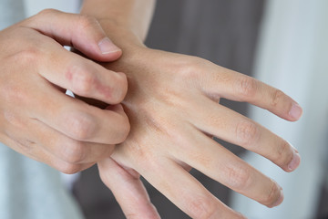 Young asian man itching and scratching on hand from itchy dry skin eczema dermatitis
