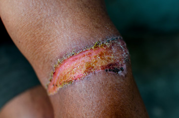 Fototapeta premium Severe Scab wound infected in skin on man arm close up.Health care concept.
