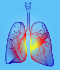 Illustration of human lungs affected with disease on light blue background