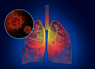 Illustration of human lungs affected with disease on blue background