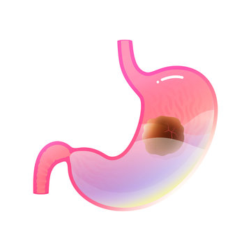 Vector isolated illustration of stomach cancer 