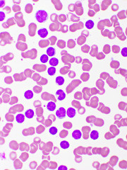 Picture of acute lymphocytic leukemia or ALL cells in blood smear, analyze by microscope, 1000x